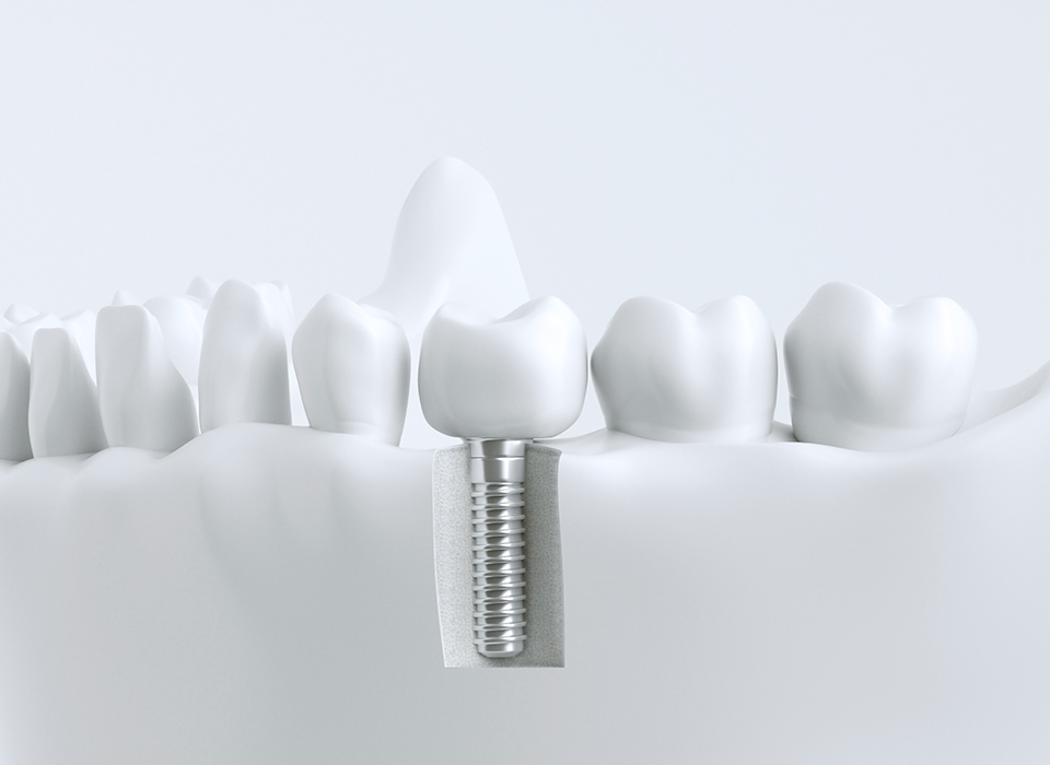 가이드 임플란트